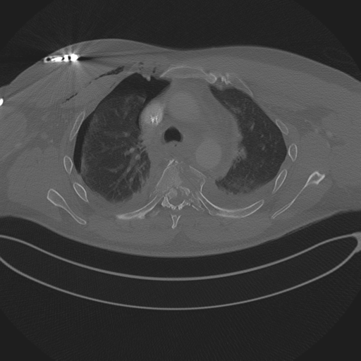 Chest multitrauma - aortic injury (Radiopaedia 34708-36147 Axial bone window 101).png