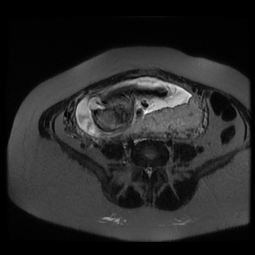 Chiari II malformation - fetal MRI (Radiopaedia 68099-77581 Axial T2-SSFSE 25).jpg