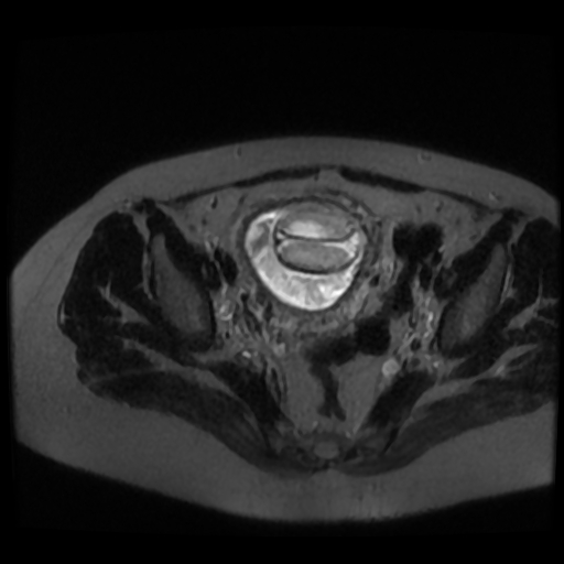 Chiari II malformation - fetal MRI (Radiopaedia 68099-77581 Axial T2-SSFSE 52).jpg