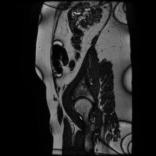 Chiari II malformation - fetal MRI (Radiopaedia 68099-77581 Sagittal Fiesta 52).jpg