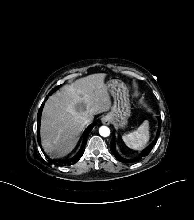 Cholangiocarcinoma with cerebral metastases (Radiopaedia 83519-98629 B 12).jpg