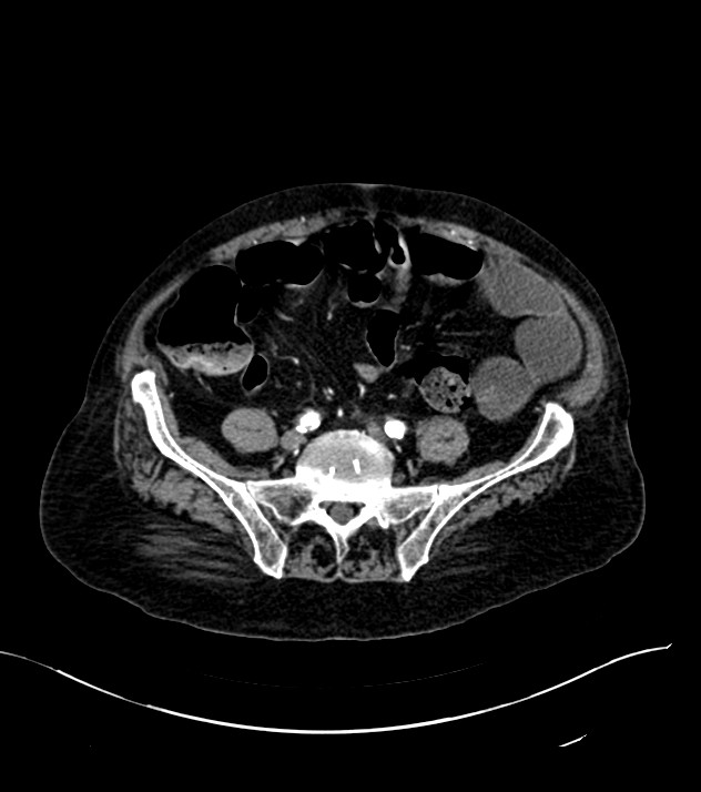 Cholangiocarcinoma with cerebral metastases (Radiopaedia 83519-98629 B 87).jpg