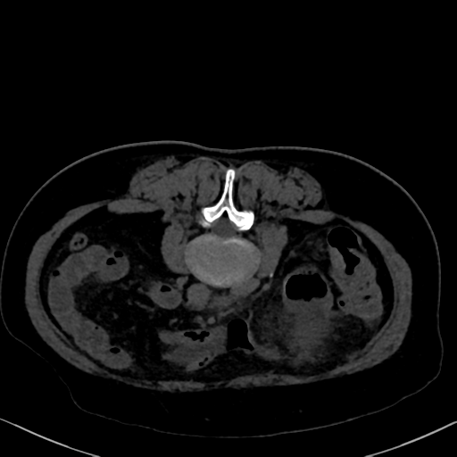File:Cholecystitis - obstructive choledocholitiasis (CT intravenous cholangiography) (Radiopaedia 43966-47479 Axial 66).png