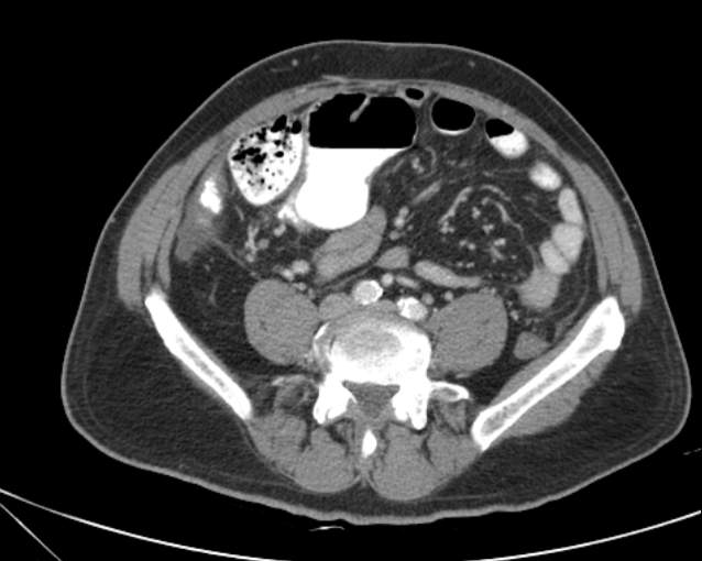 Cholecystitis - perforated gallbladder (Radiopaedia 57038-63916 A 55).jpg
