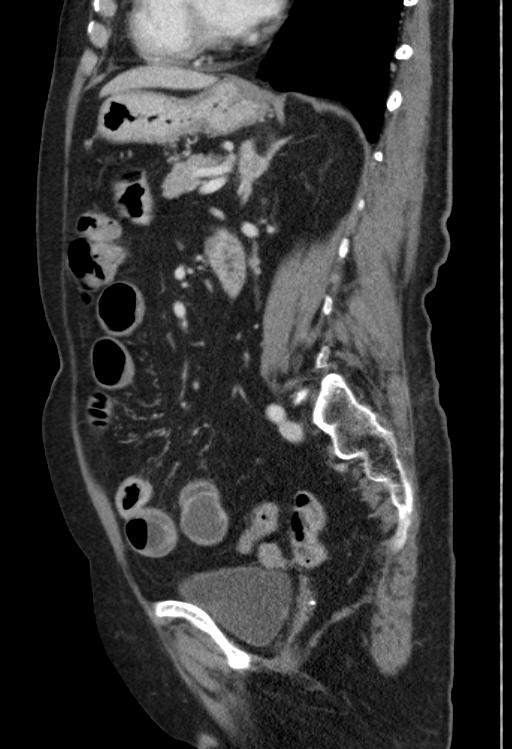 Cholecystoduodenal fistula due to calculous cholecystitis with gallstone migration (Radiopaedia 86875-103077 F 24).jpg