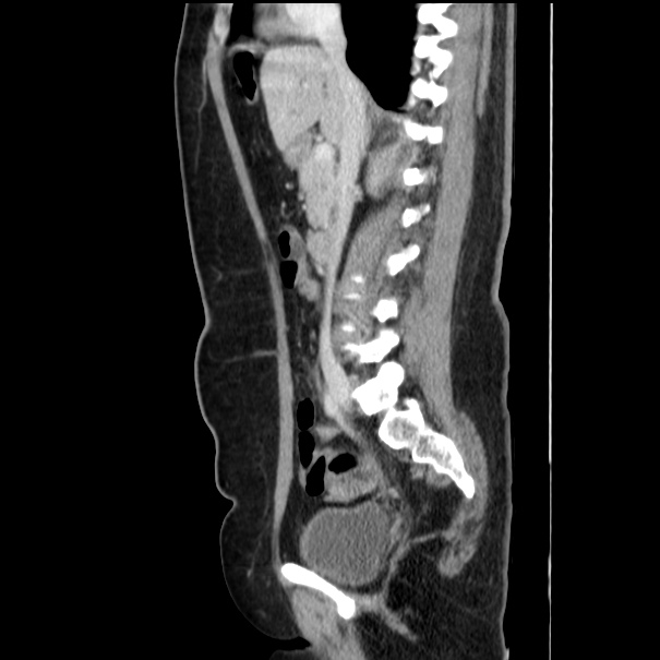 Choledocholithiasis on CT and MRI (Radiopaedia 24825-25087 D 29).jpg
