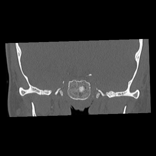File:Cholesteatoma (Radiopaedia 84960-100474 Coronal bone window 14).jpg