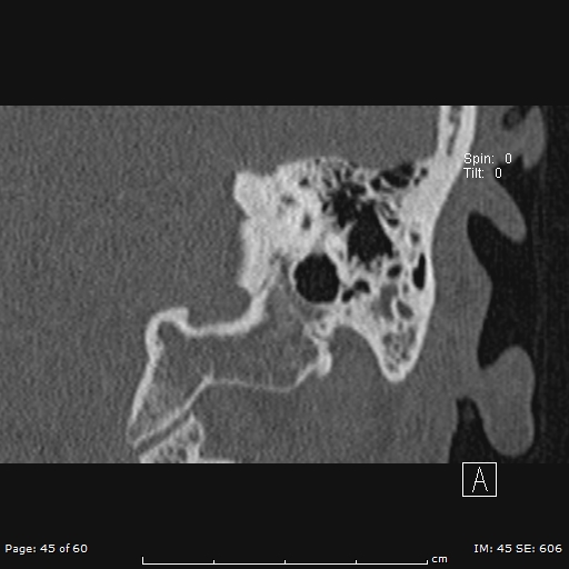 Cholesteatoma - external auditory canal (Radiopaedia 88452-105096 Coronal bone window 45).jpg
