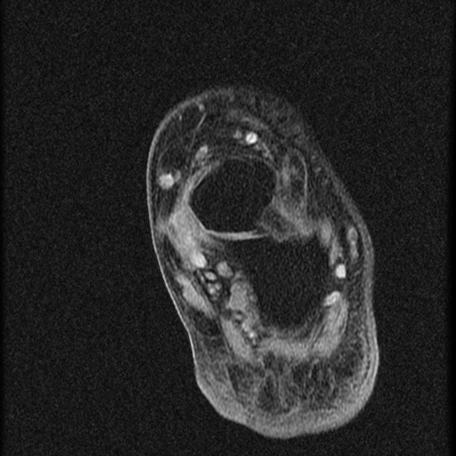 File:Chondroblastoma - midfoot (Radiopaedia 64831-73765 F 5).jpg