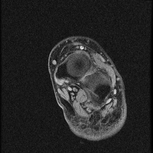 File:Chondroblastoma - midfoot (Radiopaedia 64831-73765 F 8).jpg