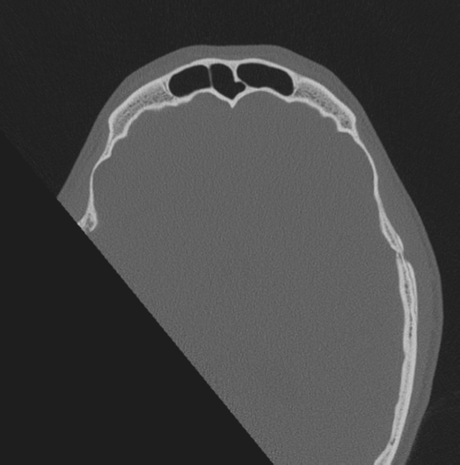 Chondrosarcoma (clivus) (Radiopaedia 46895-51425 Axial bone window 4).png