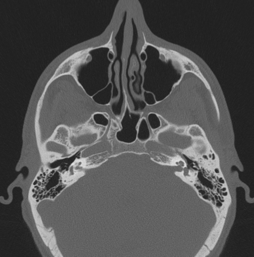 File:Chondrosarcoma (clivus) (Radiopaedia 46895-51425 Axial bone window 48).png