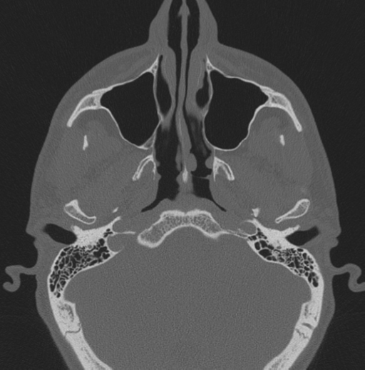 Chondrosarcoma (clivus) (Radiopaedia 46895-51425 Axial bone window 58).png