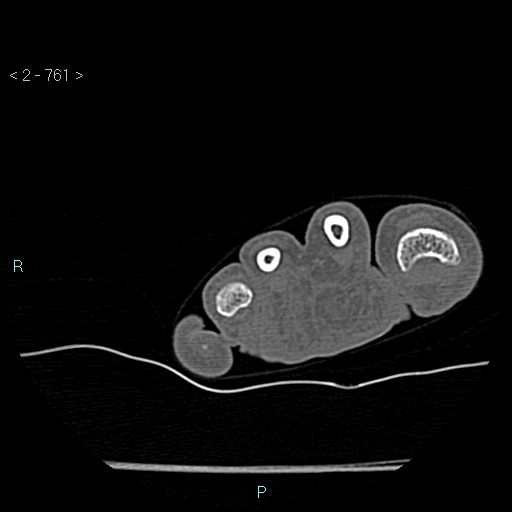 File:Chondrosarcoma - phalanx (Radiopaedia 69047-78812 Axial bone window 15).jpg