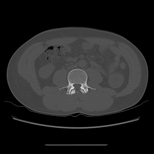 File:Chondrosarcoma of iliac wing (Radiopaedia 63861-72599 Axial bone window 4).jpg