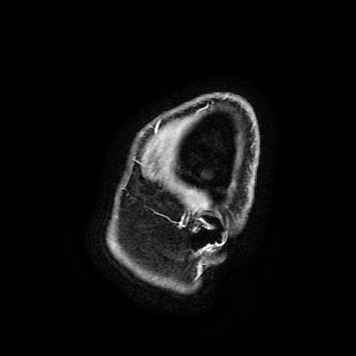 Chordoid glioma of third ventricle (Radiopaedia 91612-109340 F 196).jpg