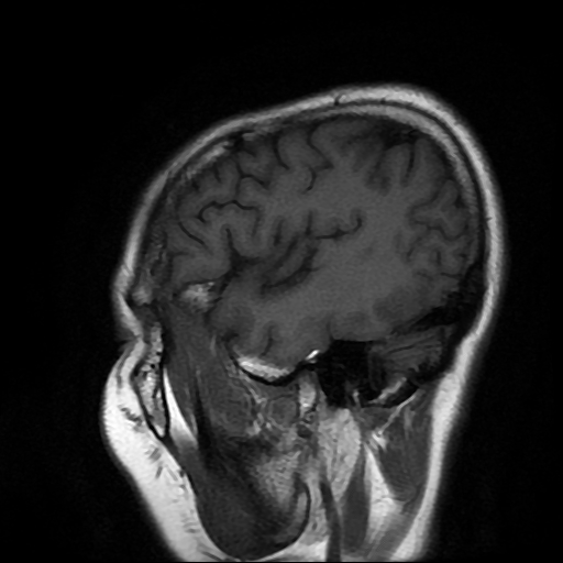 File:Chordoid glioma of third ventricle (Radiopaedia 91612-109340 Sagittal T1 3).jpg