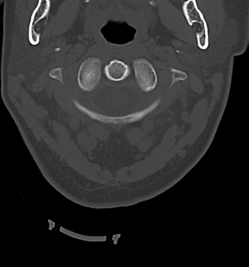 Chordoma (C4 vertebra) (Radiopaedia 47561-52188 Axial bone window 10).png