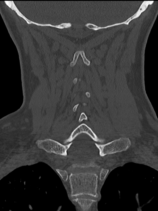 Chordoma (C4 vertebra) (Radiopaedia 47561-52188 Coronal bone window 39).png
