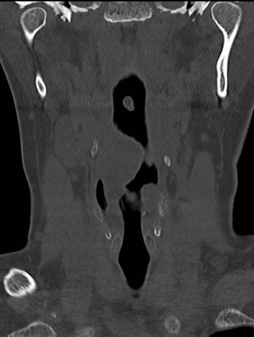 Chordoma (C4 vertebra) (Radiopaedia 47561-52188 Coronal bone window 6).png