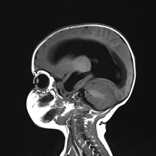 File:Choroid plexus papilloma (Radiopaedia 84612-100019 Sagittal T1 16).jpg