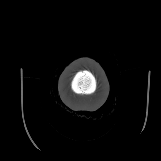 Choroid plexus papilloma extending into the cerebellopontine angle cistern (Radiopaedia 85941-101833 Axial bone window 91).png