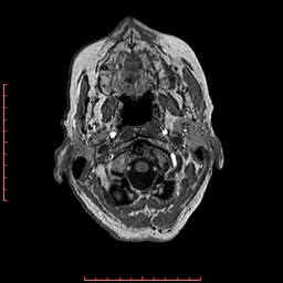 Choroid plexus xanthogranuloma (Radiopaedia 67843-77270 Axial T1 152).jpg
