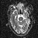 Choroid plexus xanthogranuloma - unilateral (Radiopaedia 85632-101393 Axial ADC 21).jpg