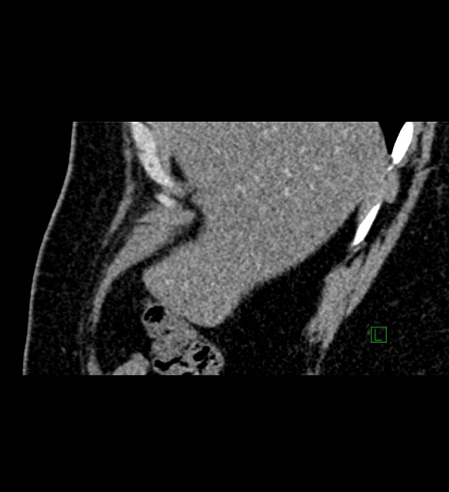 Chromophobe renal cell carcinoma (Radiopaedia 84286-99573 F 156).jpg