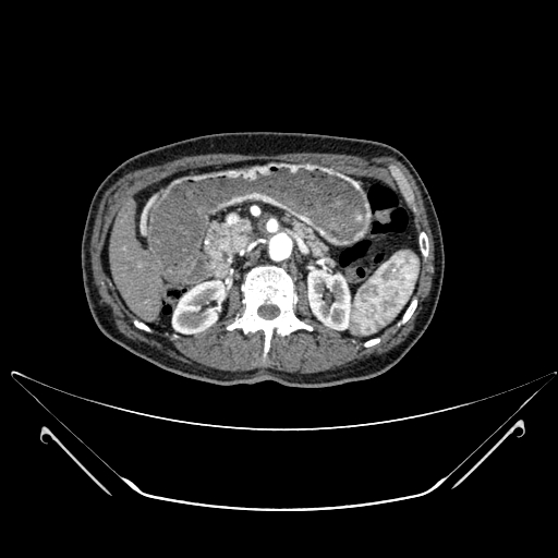 File:Chronic contained rupture of abdominal aortic aneurysm with extensive erosion of the vertebral bodies (Radiopaedia 55450-61901 A 16).jpg