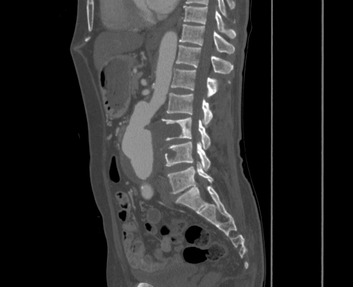 File:Chronic contained rupture of abdominal aortic aneurysm with extensive erosion of the vertebral bodies (Radiopaedia 55450-61901 Sagittal bone window 26).jpg