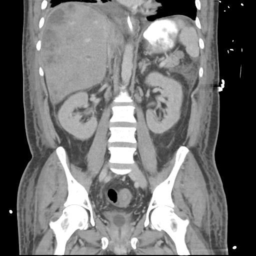 Chronic diverticulitis complicated by hepatic abscess and portal vein thrombosis (Radiopaedia 30301-30938 B 36).jpg