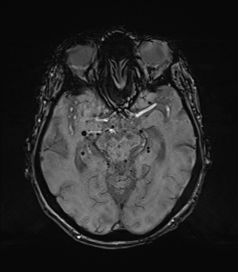 Chronic hypertensive encephalopathy (Radiopaedia 72844-83495 Axial SWI 34).png