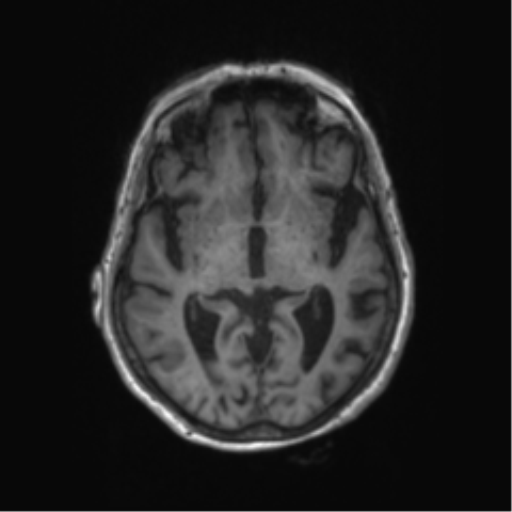 Chronic hypertensive encephalopathy (Radiopaedia 72844-83495 Axial T1 40).png