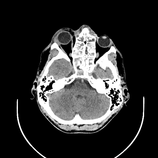 Chronic invasive fungal sinusitis (Radiopaedia 50342-55710 Axial non-contrast 43).jpg