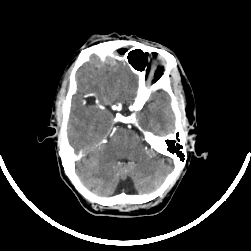 Chronic invasive fungal sinusitis with intraorbital and intracranial extension (Radiopaedia 56387-63046 B 121).jpg