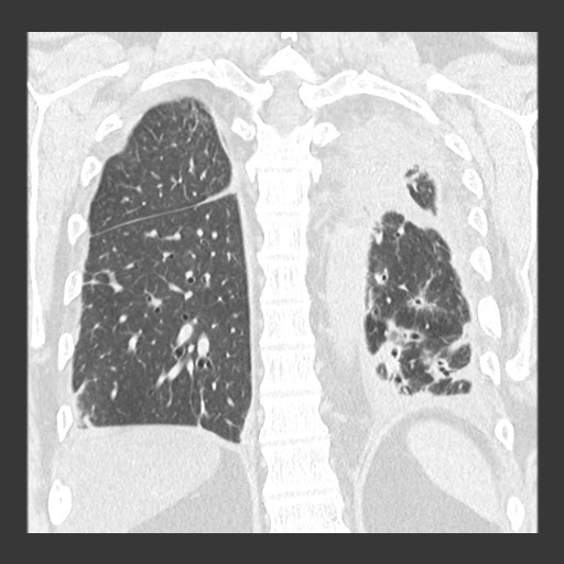 Chronic lung allograft dysfunction - restrictive form (Radiopaedia 60595-68316 Coronal lung window 73).jpg