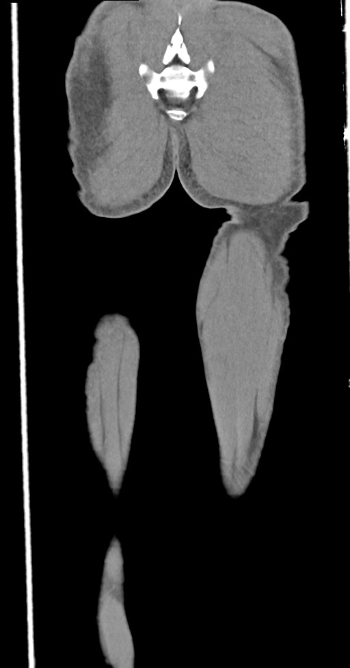 Chronic osteomyelitis (with sequestrum) (Radiopaedia 74813-85822 E 53).jpg