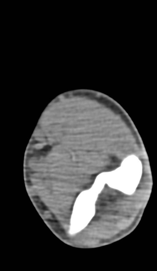 Chronic osteomyelitis of the distal humerus (Radiopaedia 78351-90971 Axial non-contrast 87).jpg