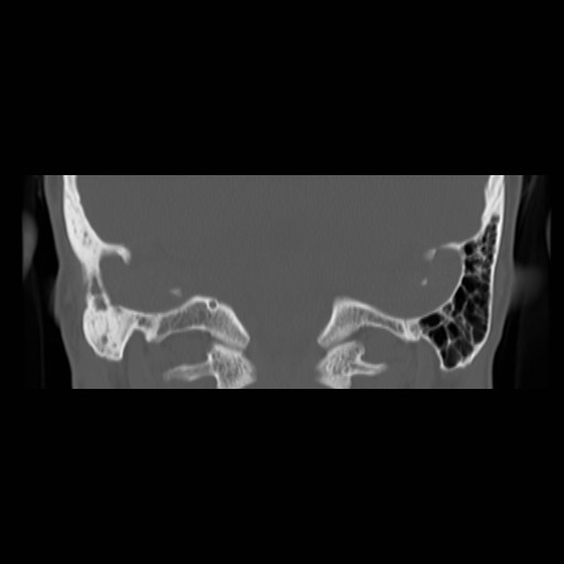File:Chronic otomastoiditis (Radiopaedia 27138-27309 Coronal bone window 18).jpg