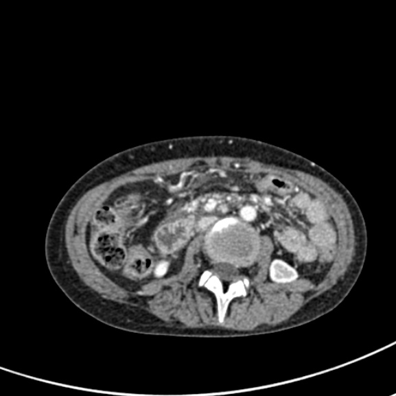 Chronic pancreatitis (Radiopaedia 55405-61846 A 51).jpg