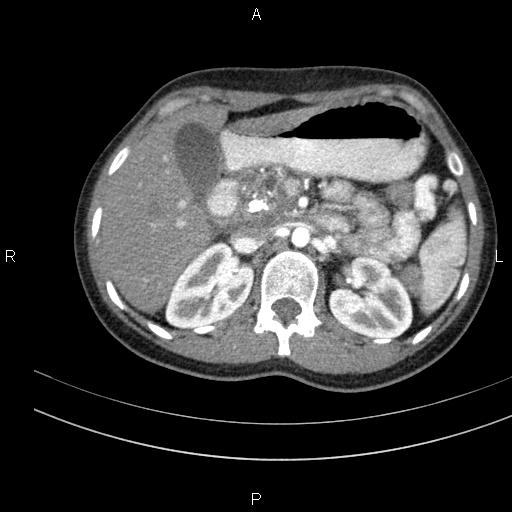 File:Chronic pancreatitis (Radiopaedia 64576-73450 B 49).jpg