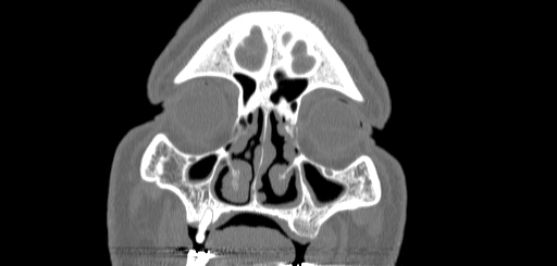 File:Chronic sphenoidal sinusitis (Radiopaedia 62030-70122 Coronal bone window 29).jpg