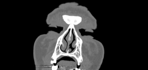 Chronic sphenoidal sinusitis (Radiopaedia 62030-70122 Coronal bone window 9).jpg