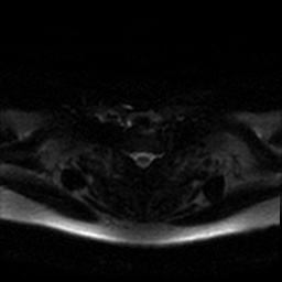 Chronic submandibular sialadenitis (Radiopaedia 61852-69885 Axial DWI 57).jpg