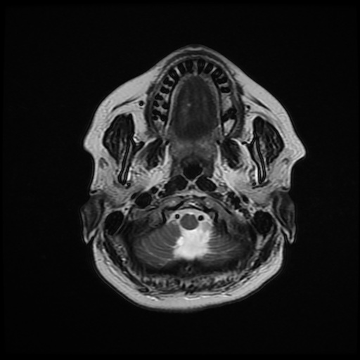 File:Chronic submandibular sialadenitis (Radiopaedia 61852-69885 Axial T2 6).jpg