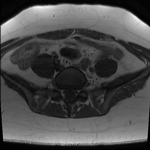 File:Class II Mullerian duct anomaly- unicornuate uterus with rudimentary horn and non-communicating cavity (Radiopaedia 39441-41755 Axial T1 2).jpg