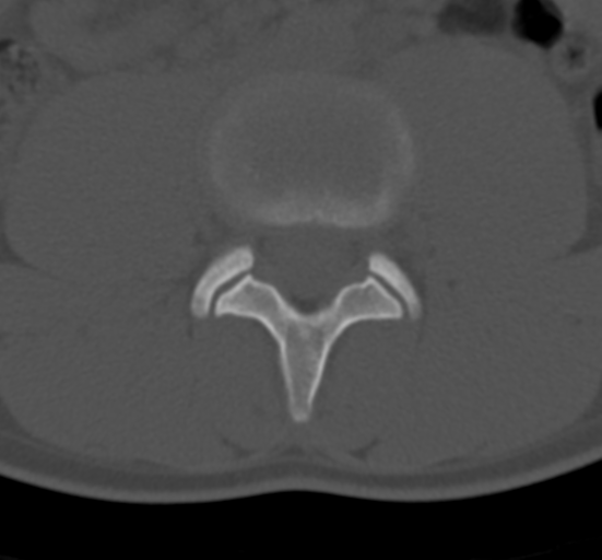 Clear cell meningoma - lumbar spine (Radiopaedia 60116-67691 Axial bone window 45).png