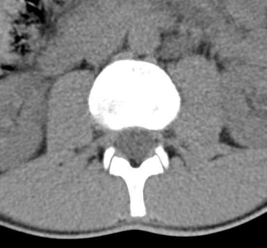File:Clear cell meningoma - lumbar spine (Radiopaedia 60116-67691 Axial non-contrast 22).png