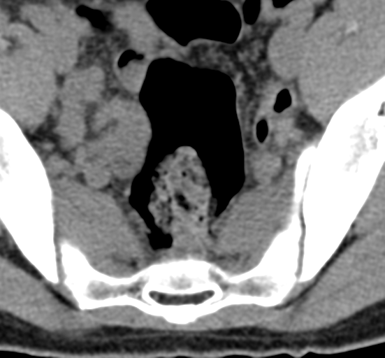 File:Clear cell meningoma - lumbar spine (Radiopaedia 60116-67691 Axial non-contrast 82).png